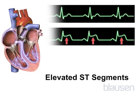 Sindromi coronariche acute (attacco cardiaco; infarto miocardico 